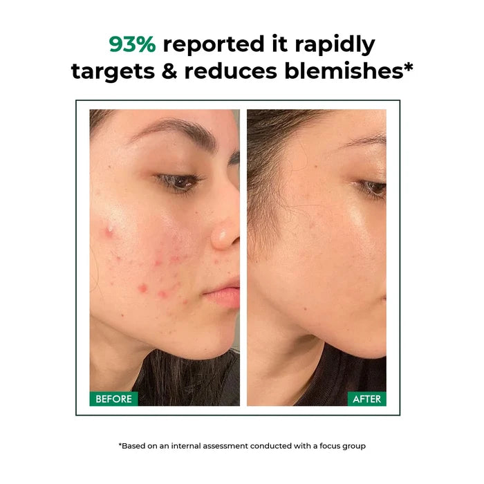 Acne Care Duo | Spot Corrector Gel + Microneedle Patches for Fast Healing & Scar-Free Skin