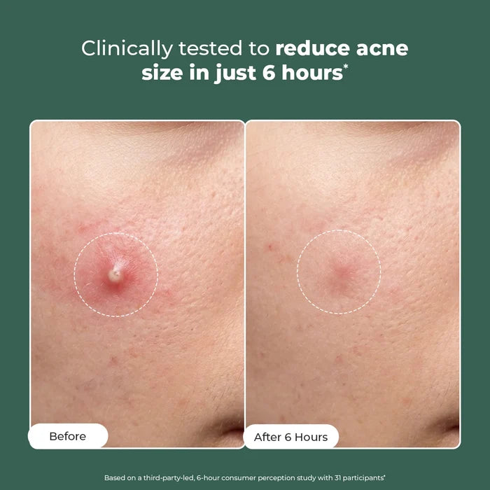Acne Spot Corrector Gel ( Pack Of 2) | 2x15 ml  | Super Saver Sale