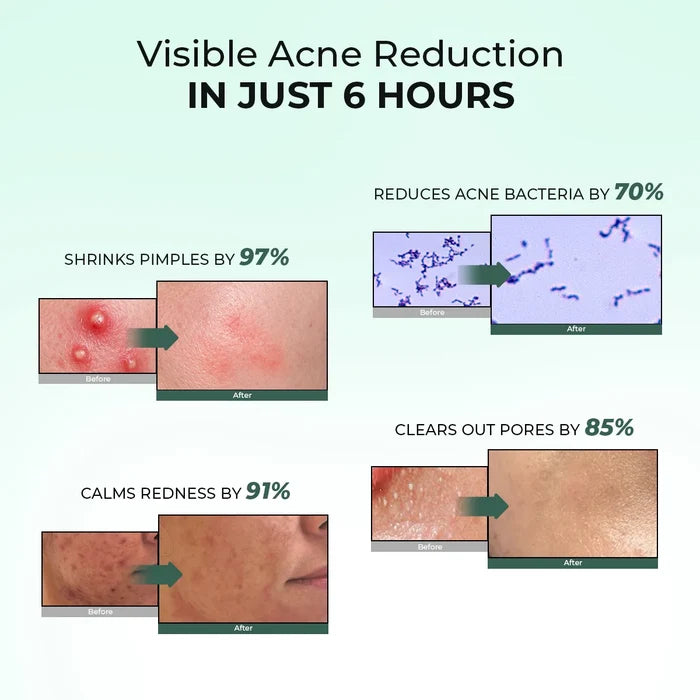 Acne Spot Corrector Gel ( Pack Of 2) | 2x15 ml  | Super Saver Sale
