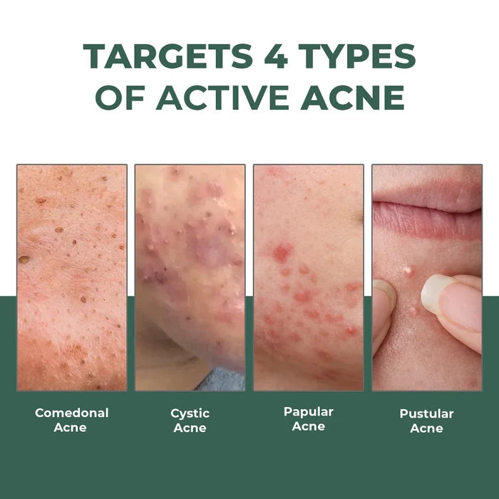 Acne Spot Corrector Gel ( Pack Of 2) | 2x15 ml  | Super Saver Sale