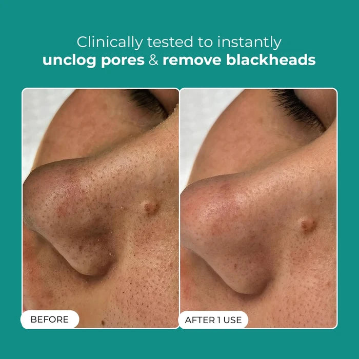 Blackhead Melting Water + Toolkit |  130 ml + 1  Nos. | Super Saver Sale