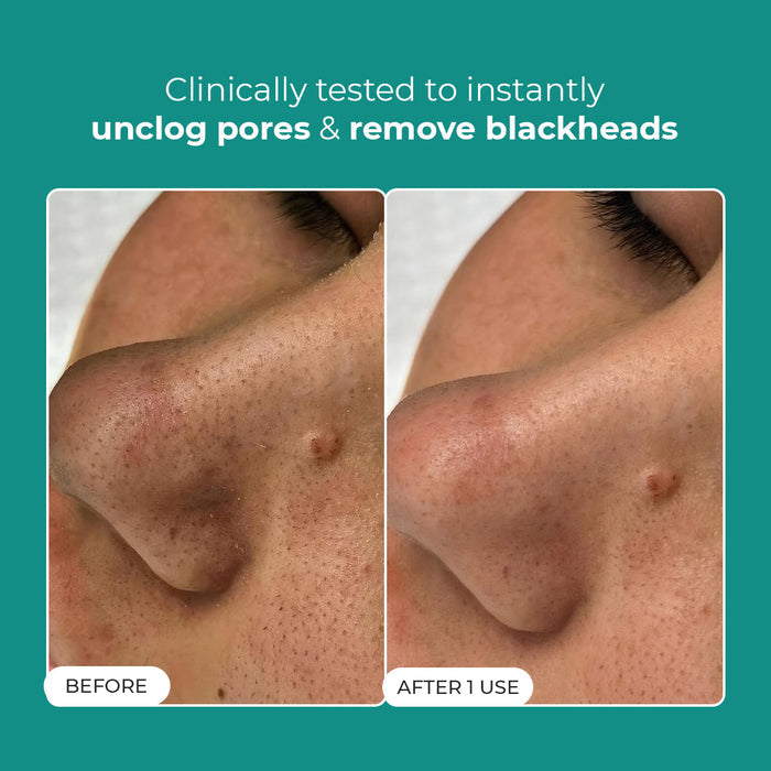 Blackhead Removal Combo | Blackhead Melting Water Mini (Pack of 2) + Blackhead Remover Toolkit | 2x50 ml + 1 Toolkit