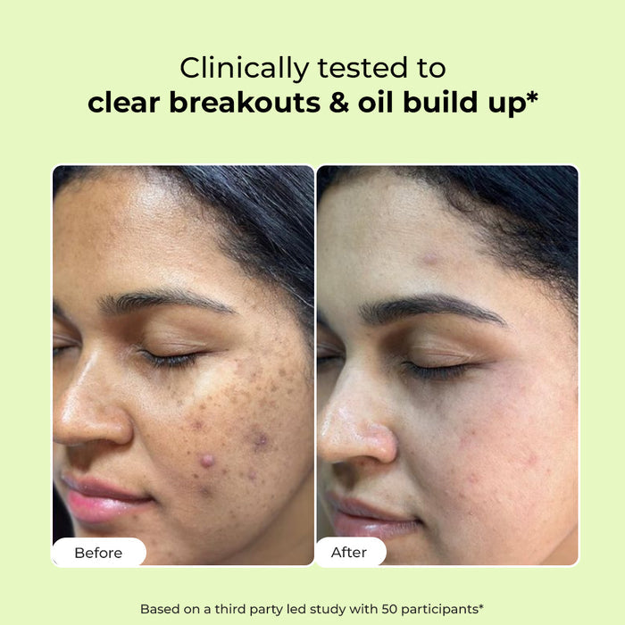 Flashfix Acne Clearing Face Wash (Pack Of 2)  | AHA, BHA & CICA Extract  | Super Saver Sale
