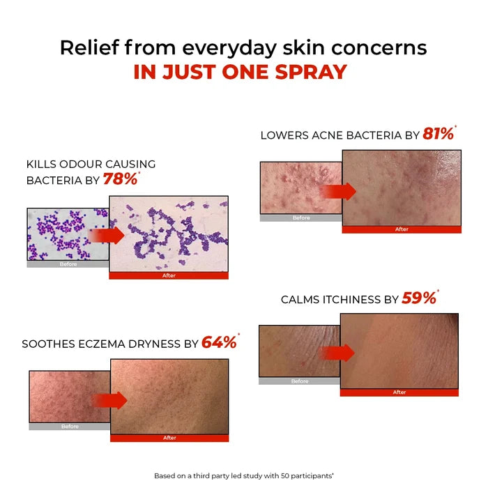 HOCL Daily Spray | Fights Body Odour, Acne & Irritation | 100 ml | Pre-Access