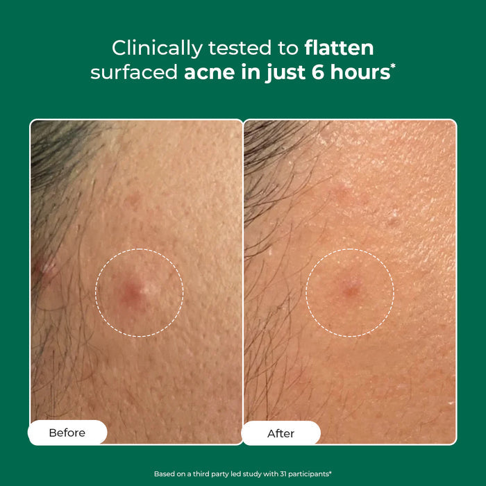 Self Dissolving Microneedle Acne Patches | 8 Patches | Best Deal